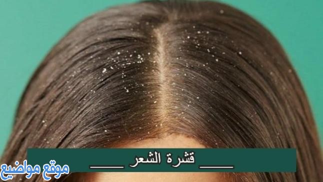 طرق علاج قشرة الشعر الدهنية
