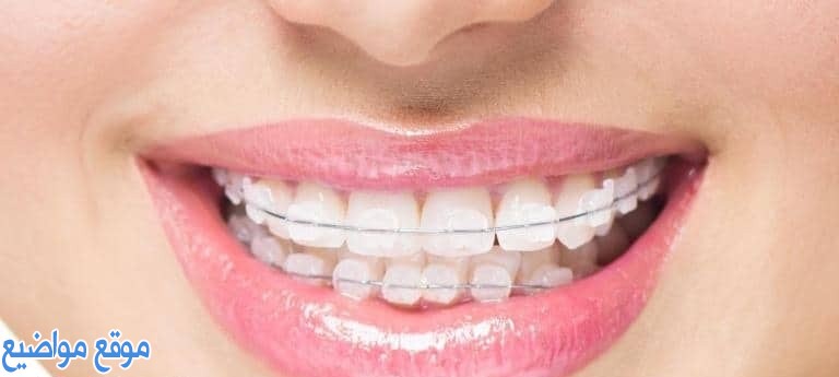تقويم الأسنان الداخلي والشفاف