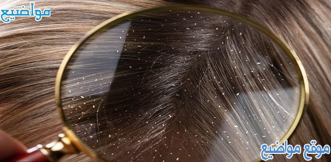 خلطات طبيعية لقشرة الشعر
