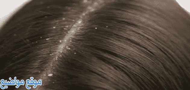 خلطات للتخلص من قشرة الشعر