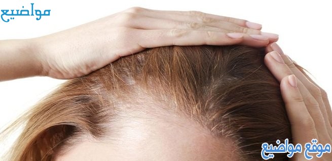 طرق علاج الثعلبة في الشعر