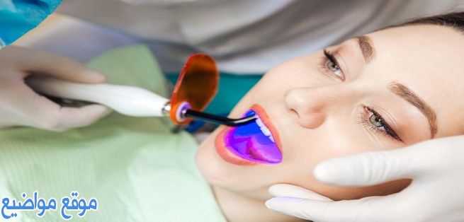 فوائد ومميزات تبييض الأسنان