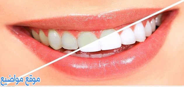 كيفية تبييض الأسنان بالفحم والليمون